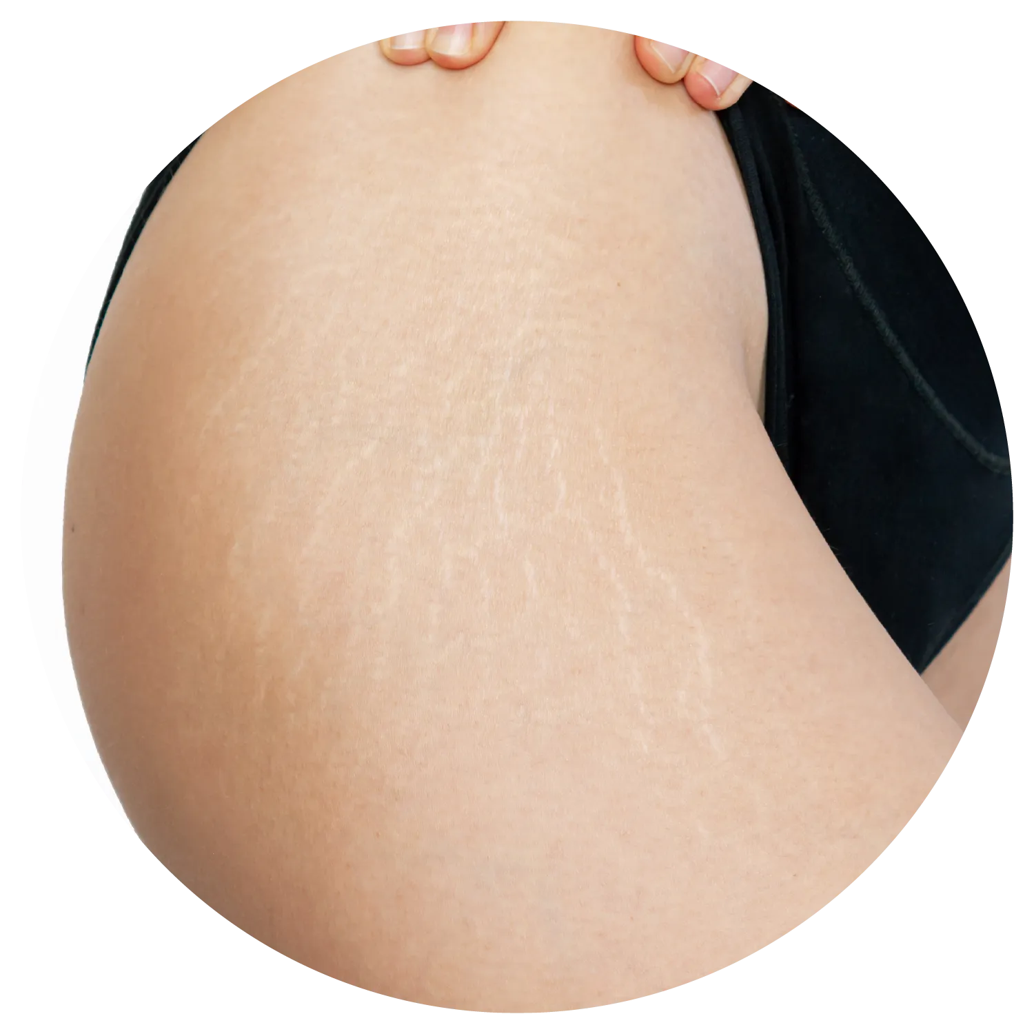 Stretch Marks treatment results at Toronto medical spa - The Chain Reaction of Symptoms